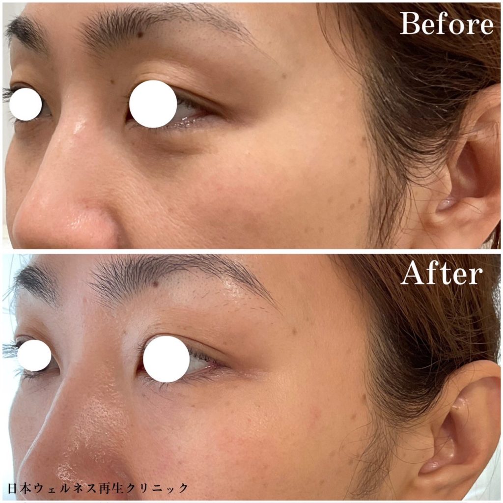 ジャルプロヤングアイ