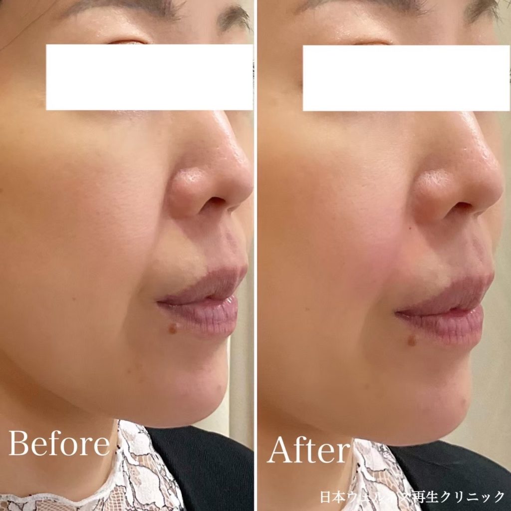 ほうれい線症例