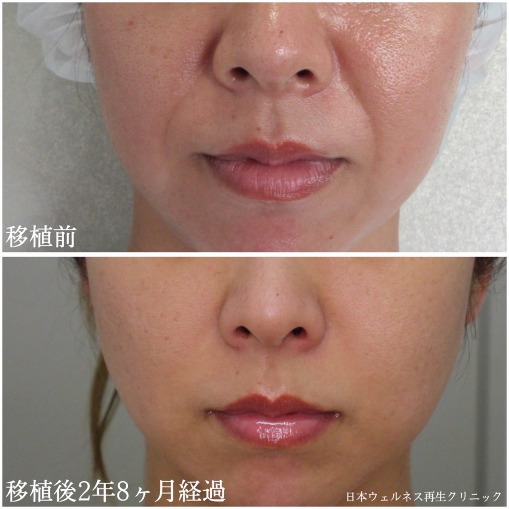 真皮線維芽細胞補充療法症例紹介