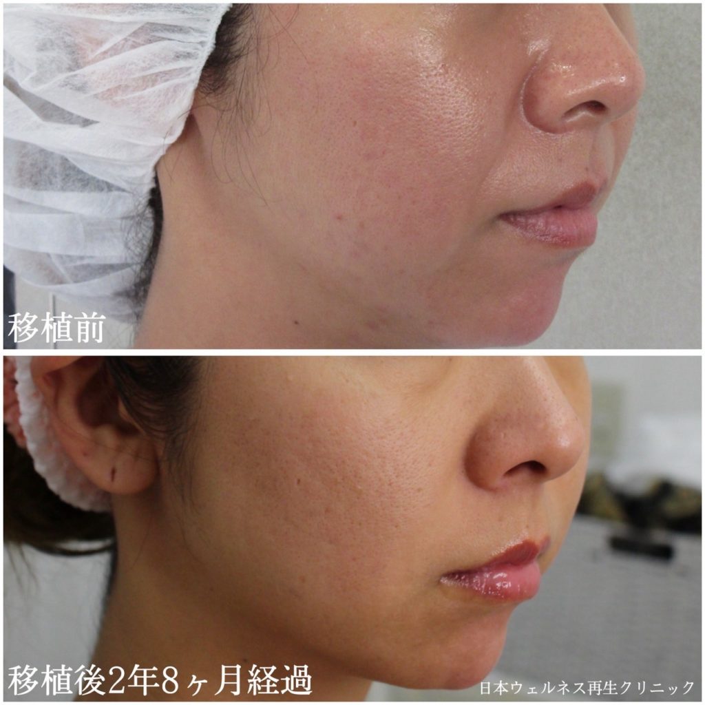 真皮線維芽細胞補充療法症例紹介