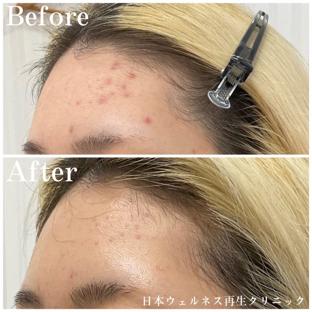 アクネスニードル症例紹介