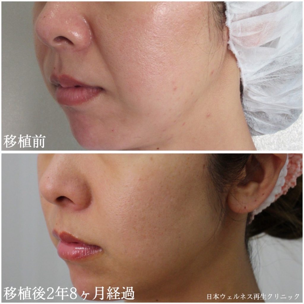 真皮線維芽細胞補充療法症例紹介