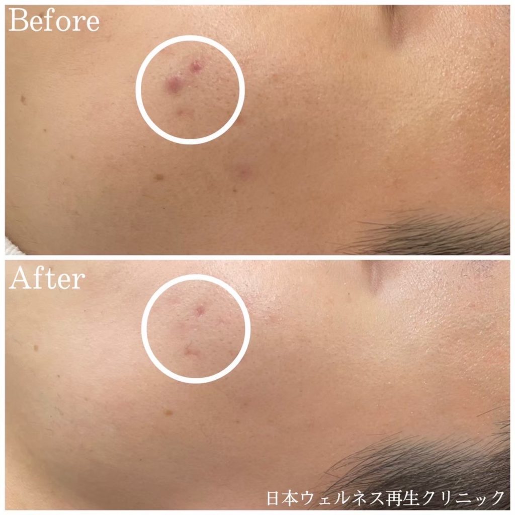 アクネスニードル症例紹介