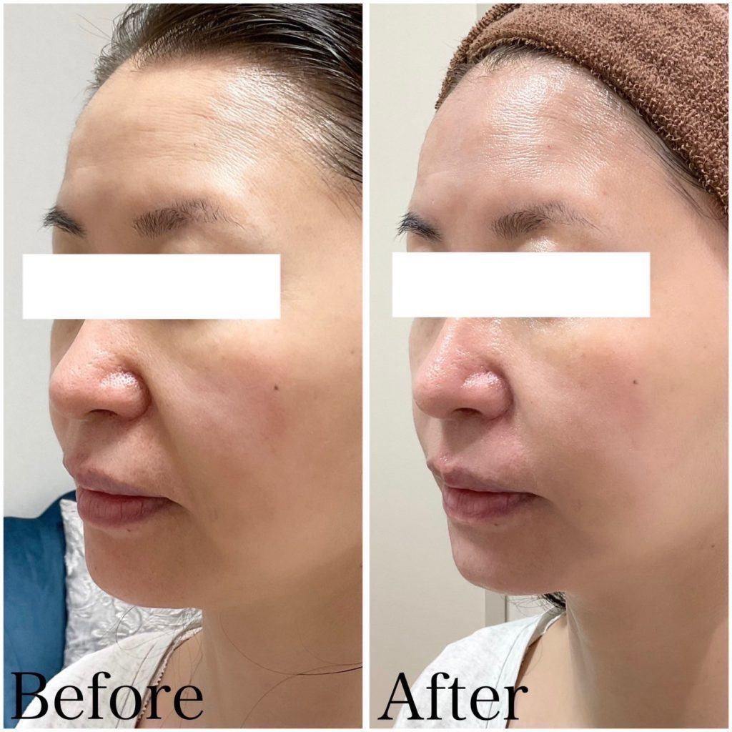 デンシティ(高周波RF)300ショット症例紹介