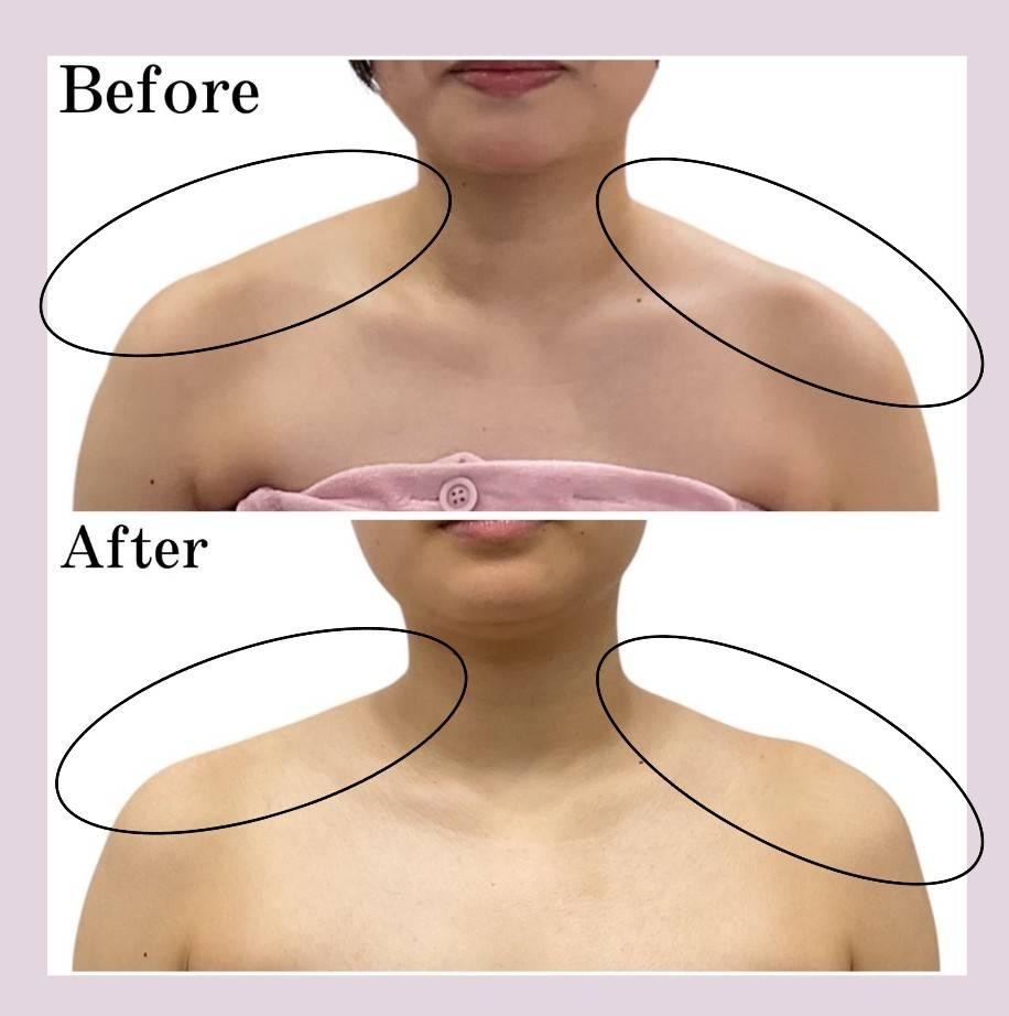 ボツラックス注射症例紹介