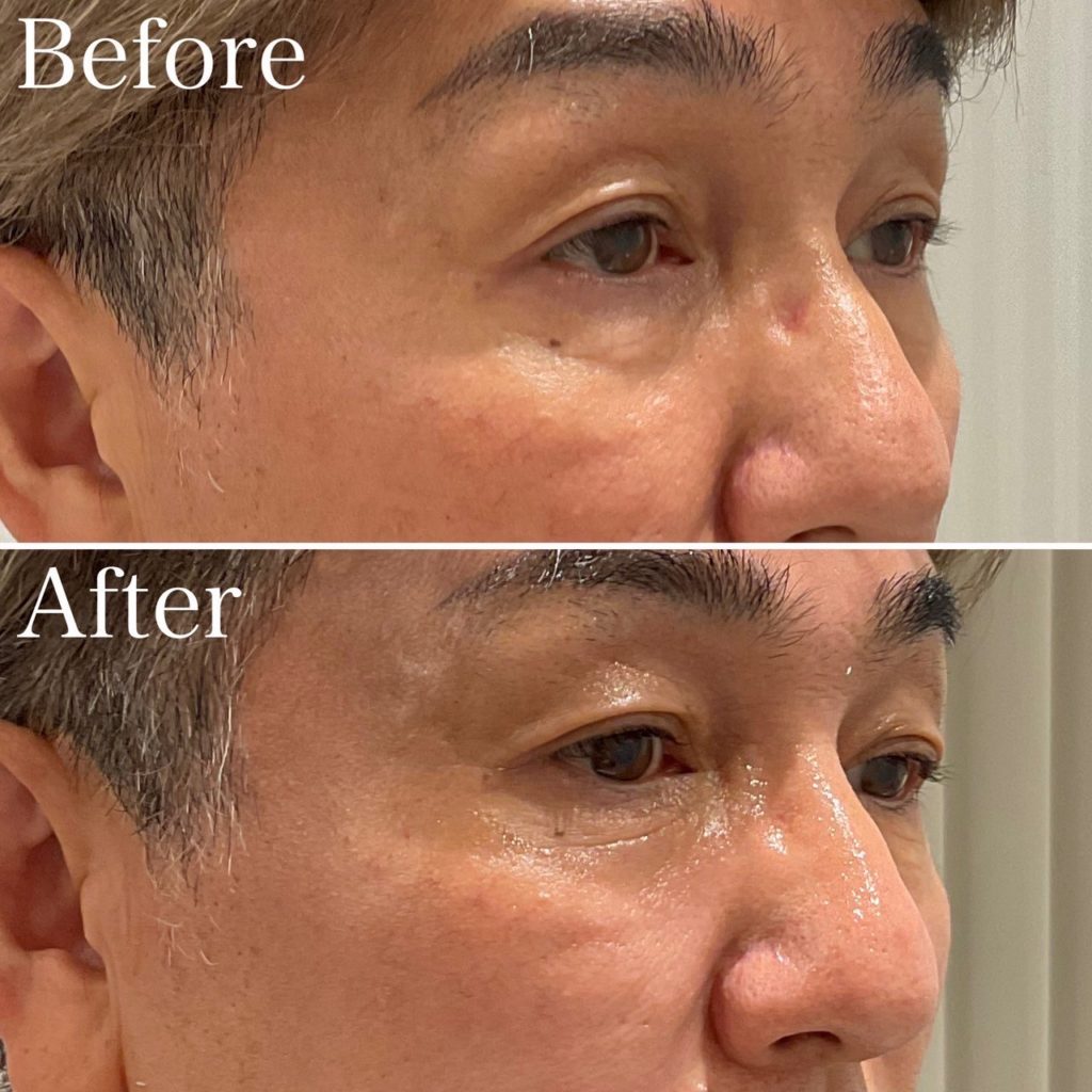 デンシティ(高周波RF)300ショット症例紹介