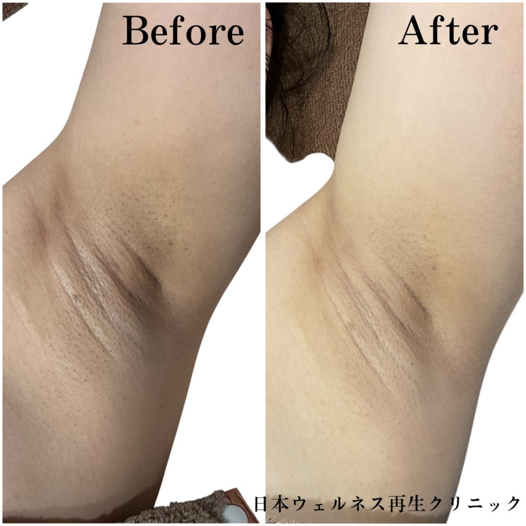 ミラノリピール症例紹介