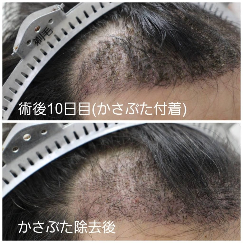 植毛FUT1700株症例紹介