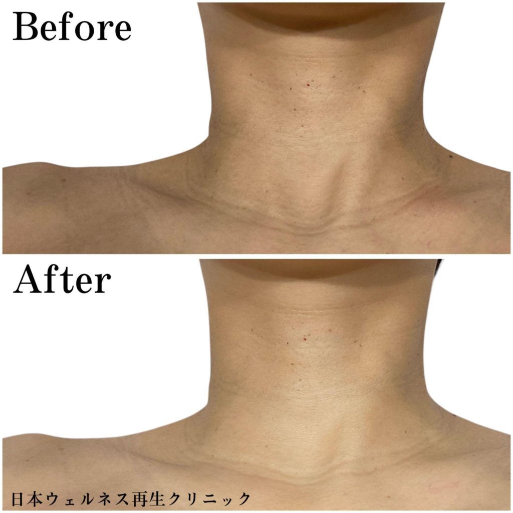 マッサージピール症例紹介