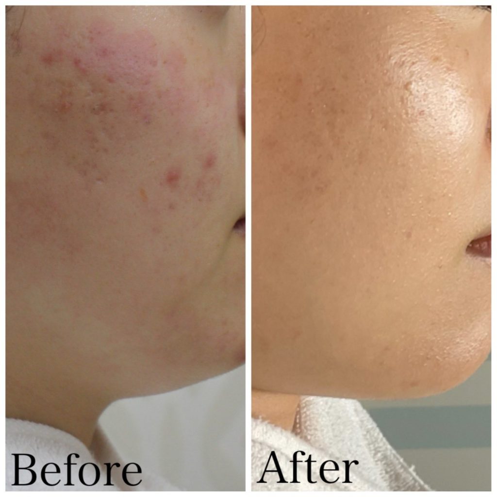 ダーマペン症例紹介