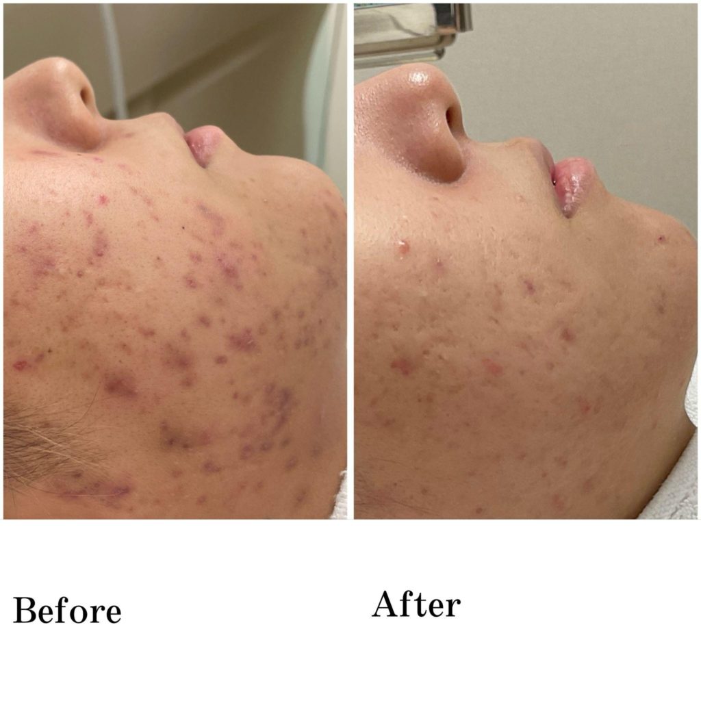 アクネスニードル症例紹介