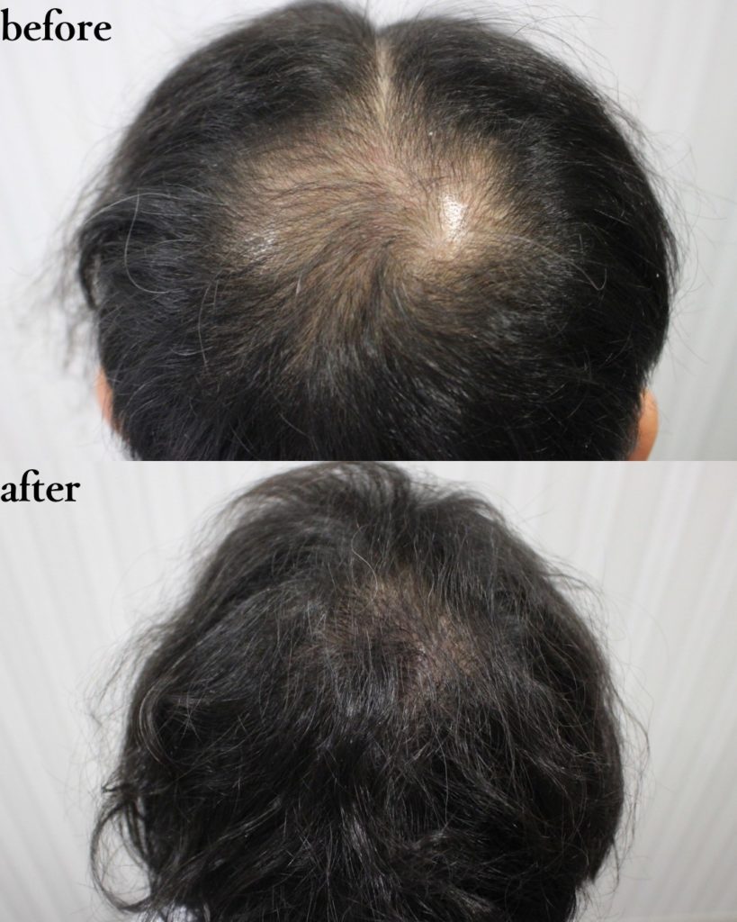 FUT術1300株症例紹介