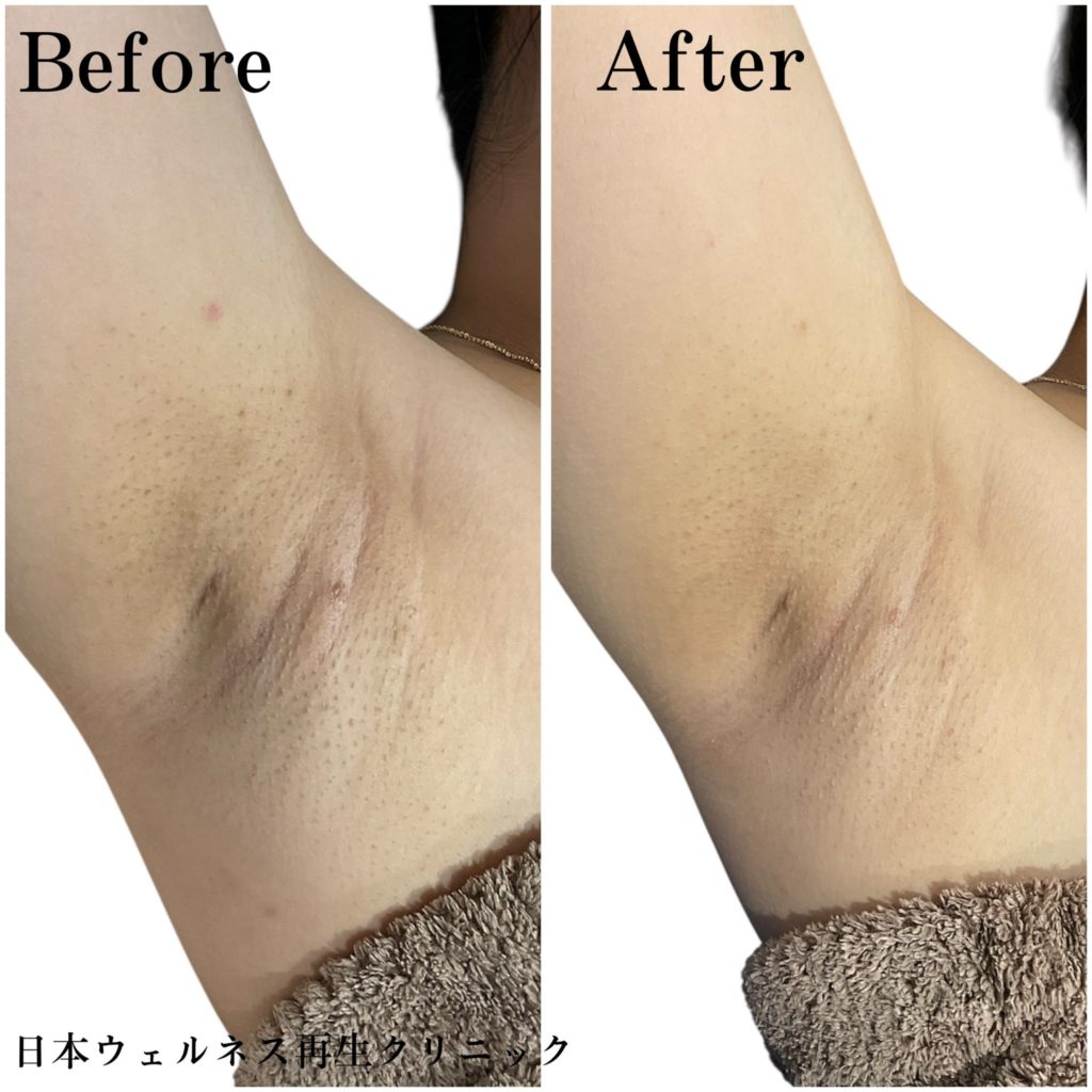 ミラノリピール症例紹介