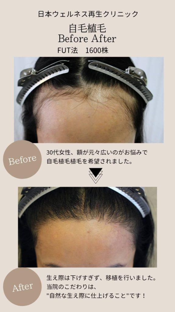 毛植毛FUT法1600株症例紹介