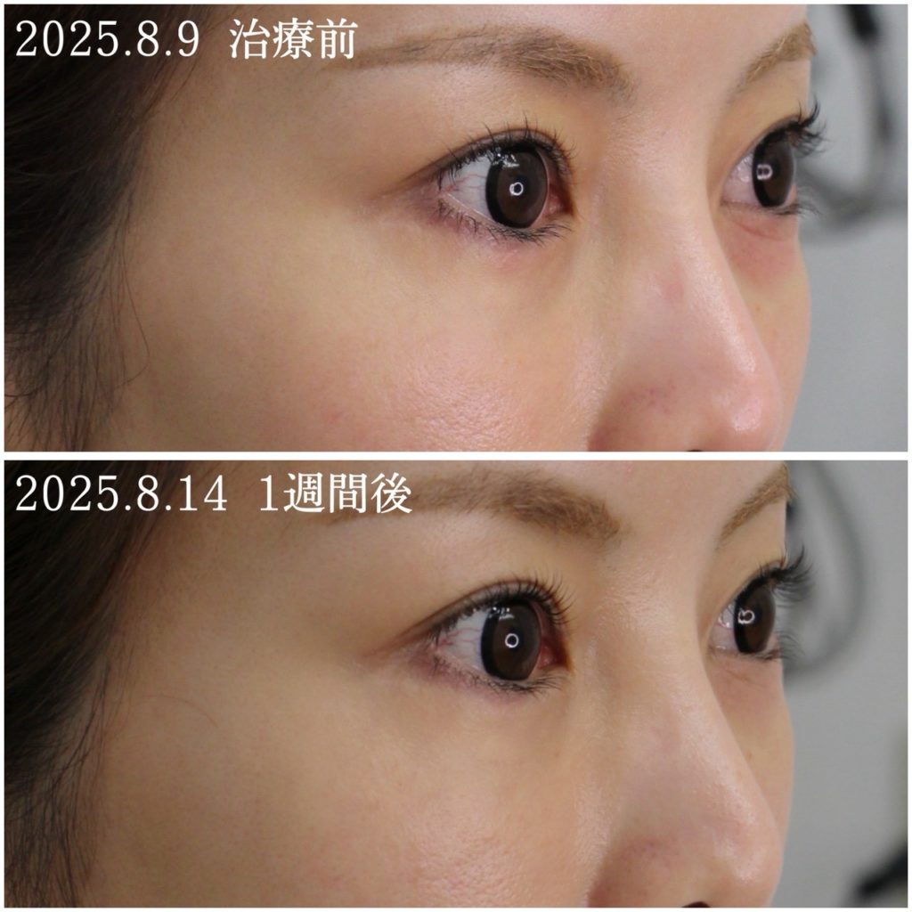 ジャルプロヤングアイ症例紹介